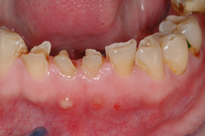 dental decay
